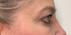 Eyelid Surgery