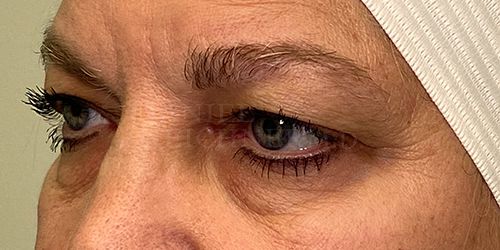 Eyelid Surgery