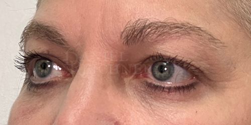 Eyelid Surgery