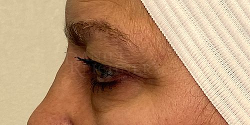 Eyelid Surgery