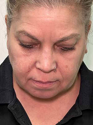 Facial Fat Grafting: Before & After Photos