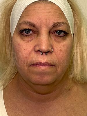 Facial Fat Grafting: Before & After Photos