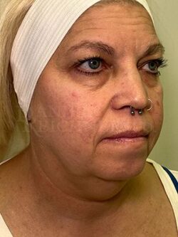 Facial Fat Grafting: Before & After Photos