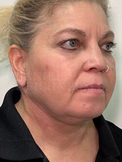 Facial Fat Grafting: Before & After Photos