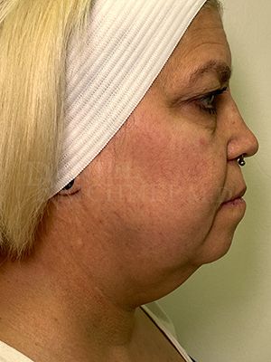 Facial Fat Grafting: Before & After Photos