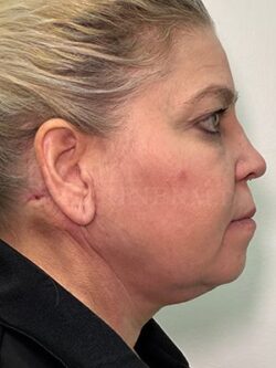 Facial Fat Grafting: Before & After Photos