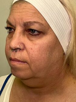 Facial Fat Grafting: Before & After Photos