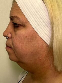 Facial Fat Grafting: Before & After Photos