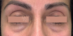 Eyelid Surgery