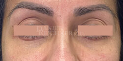 Eyelid Surgery