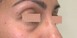 Eyelid Surgery