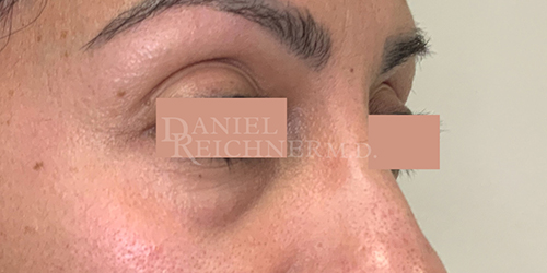 Eyelid Surgery