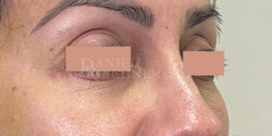 Eyelid Surgery