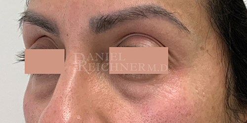 Eyelid Surgery