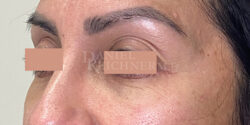 Eyelid Surgery