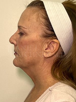 Facelift / Necklift