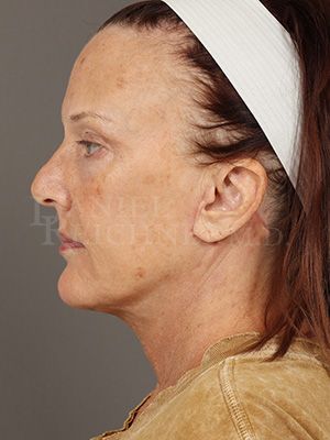 Facelift / Necklift