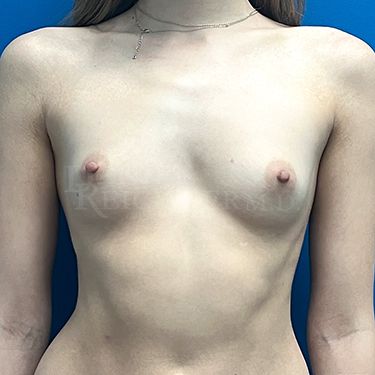 Breast Augmentation Case 19114 Before Photo Breast Augmentation