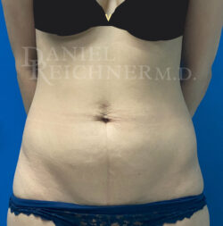 Abdominoplasty (Tummy Tuck)