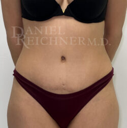 Abdominoplasty (Tummy Tuck)