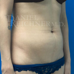 Abdominoplasty (Tummy Tuck)