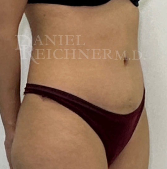 Abdominoplasty (Tummy Tuck)