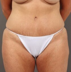 Abdominoplasty (Tummy Tuck)