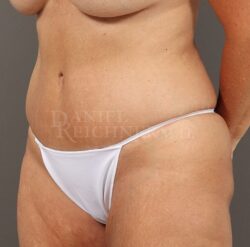 Abdominoplasty (Tummy Tuck)