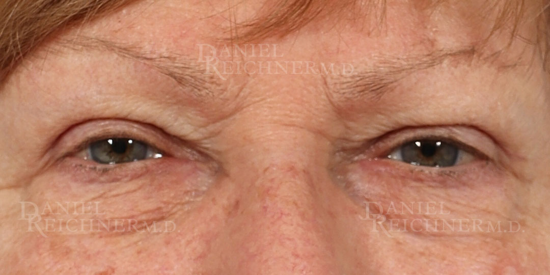 Eyelid Surgery