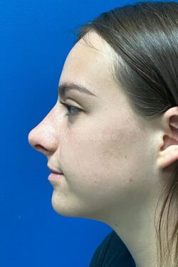 Rhinoplasty