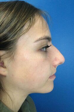 Rhinoplasty