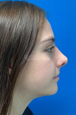 Rhinoplasty