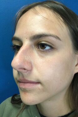 Rhinoplasty