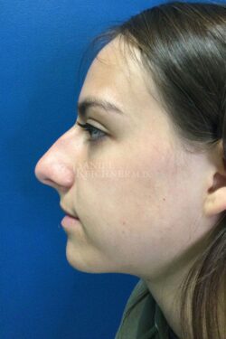 Rhinoplasty