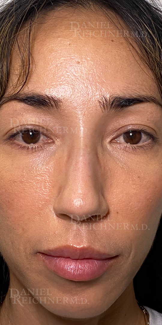 Rhinoplasty