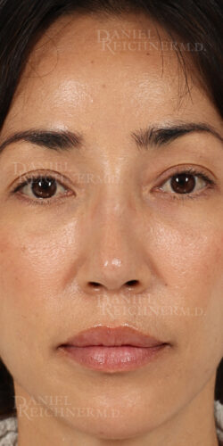 Rhinoplasty