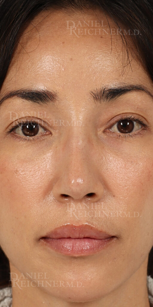 Rhinoplasty