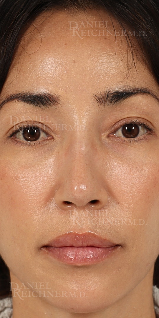 Rhinoplasty