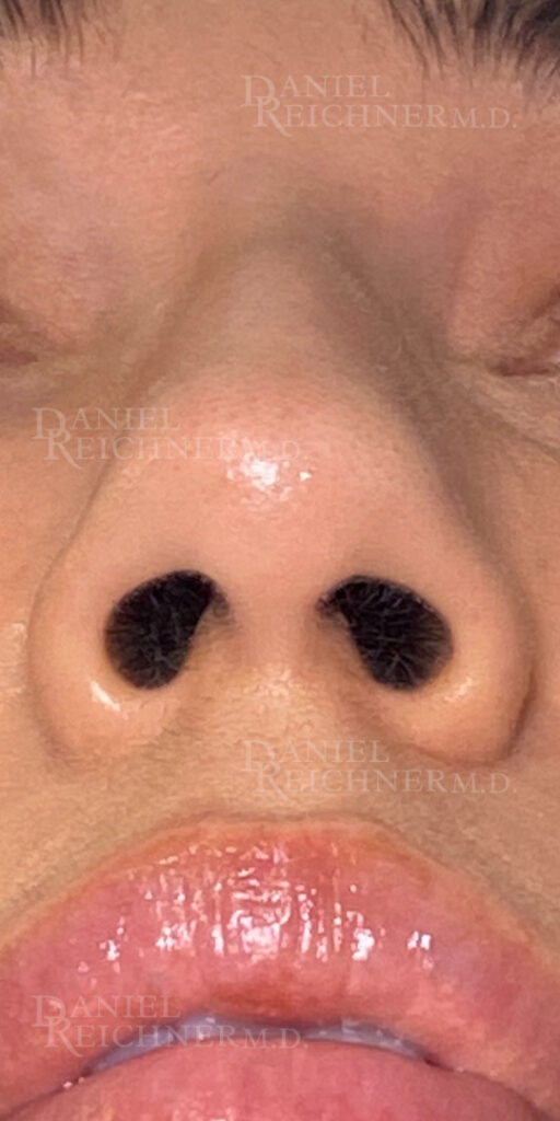 Rhinoplasty