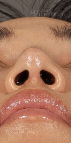 Rhinoplasty