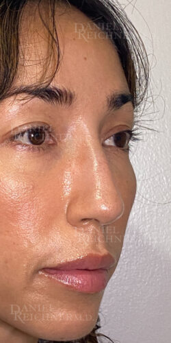 Rhinoplasty