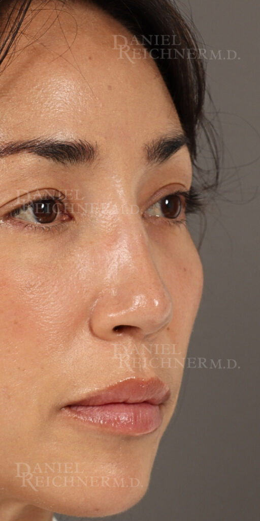 Rhinoplasty