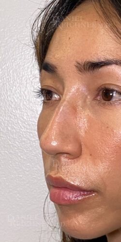 Rhinoplasty