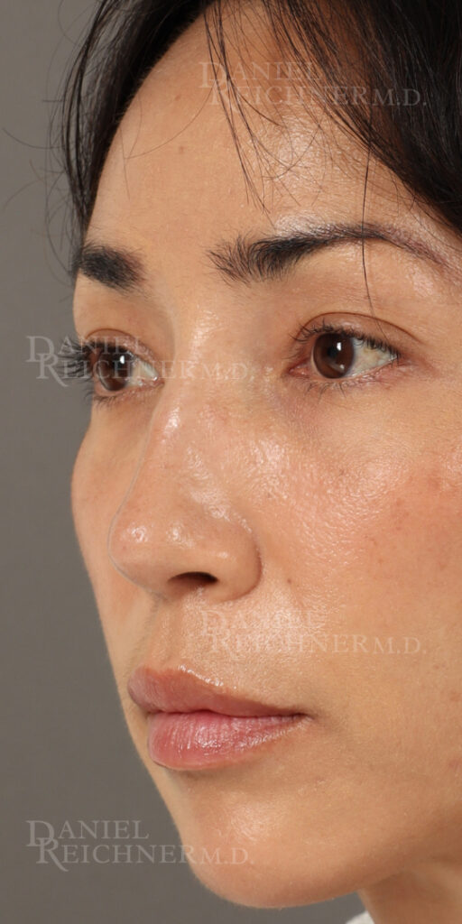 Rhinoplasty
