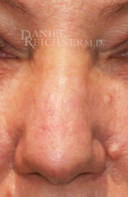 Rhinoplasty