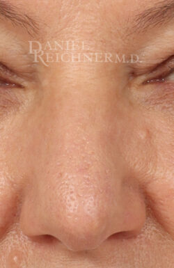Rhinoplasty