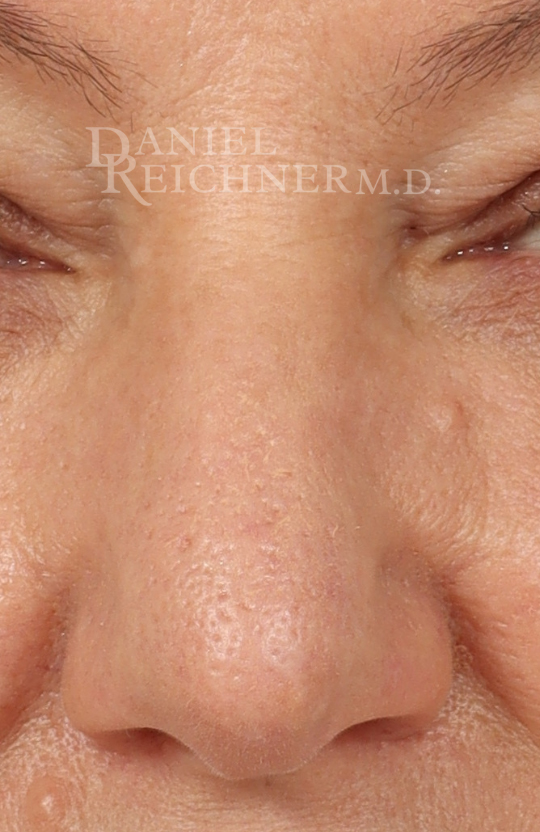 Rhinoplasty