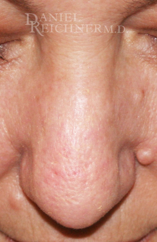 Rhinoplasty