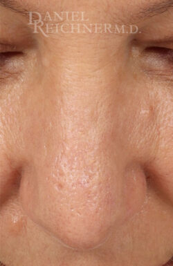 Rhinoplasty