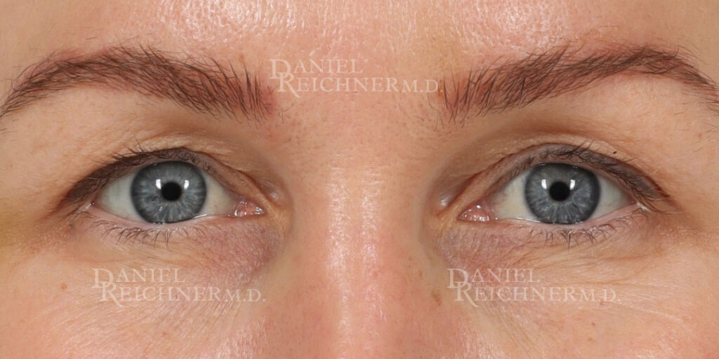 Eyelid Surgery Case 19240 Before Photo Eyelid Surgery